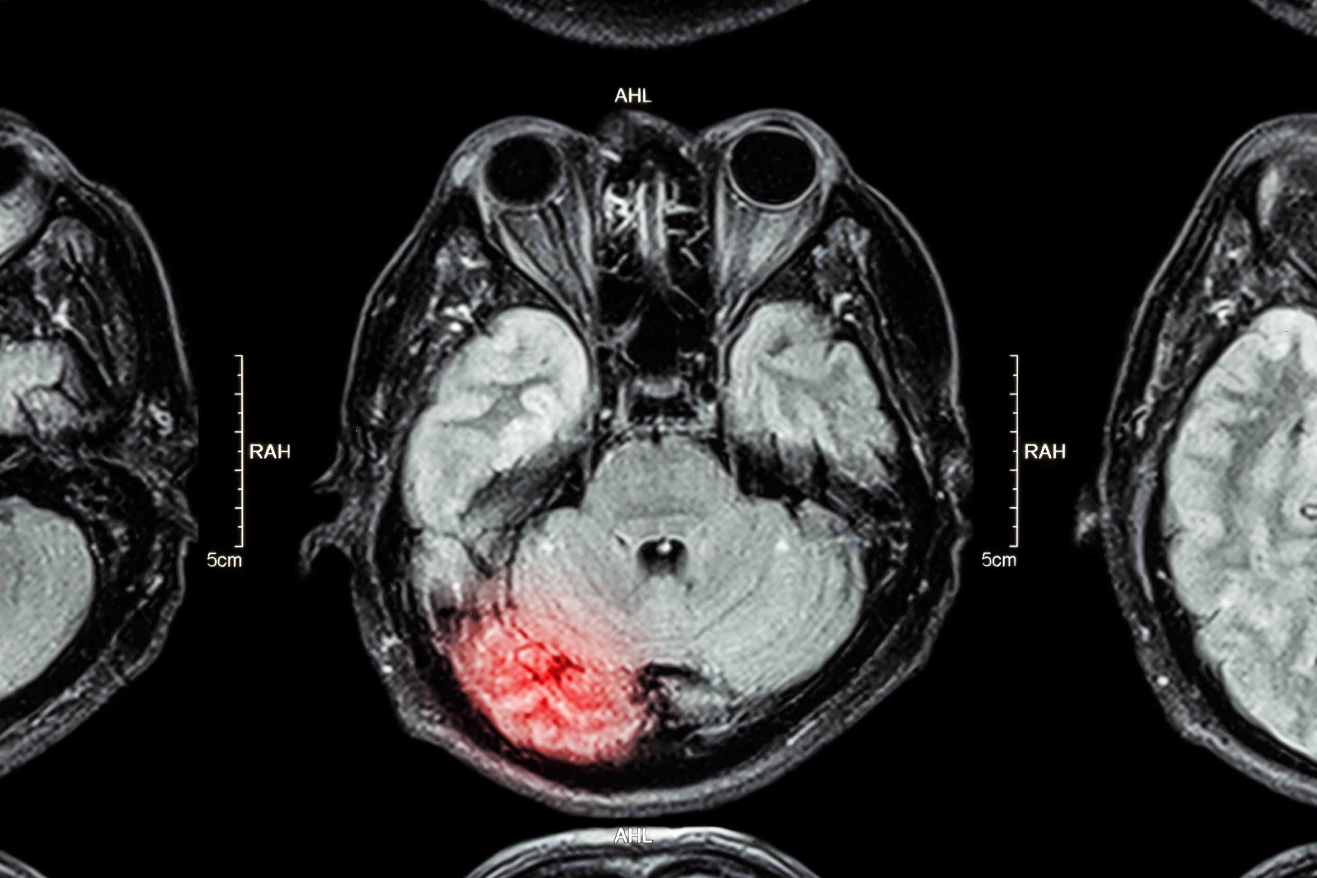 Evaluating Subjective Symptoms Due To TBI
