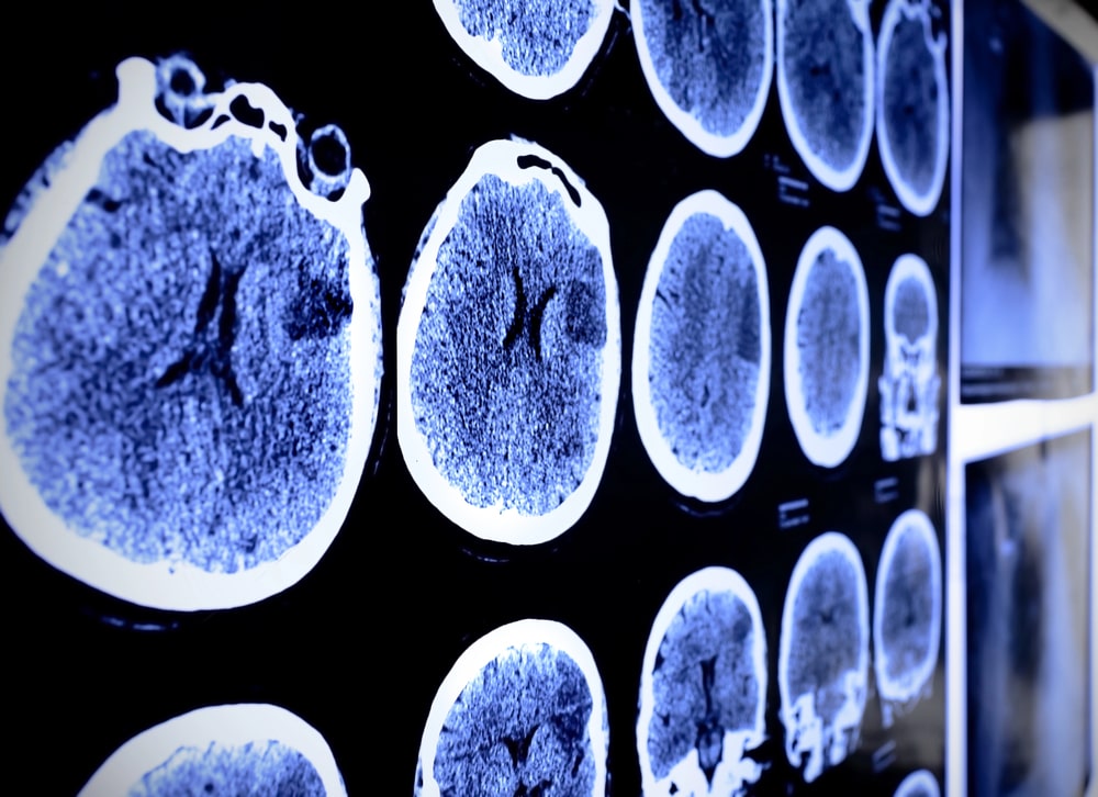 Traumatic Brain Injury (TBI)